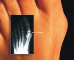 čukljevi-hallux-valgus